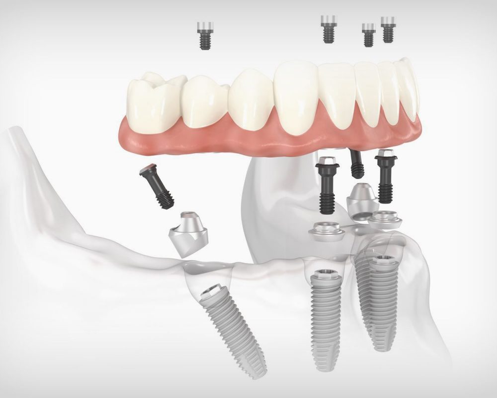 All-on-4-Behandlungskonzept.jpg